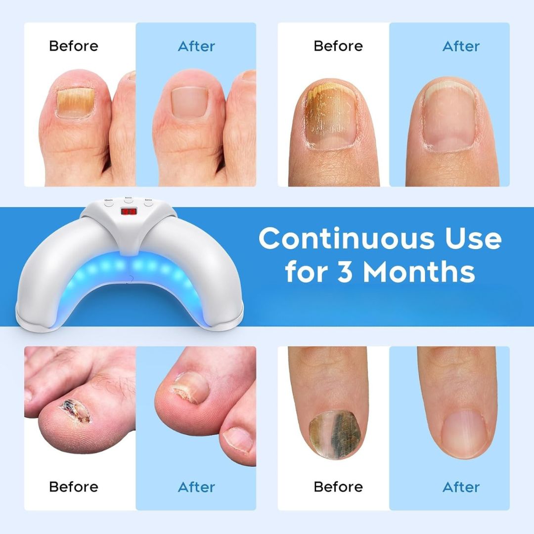 LumaCure™ Phototherapy Lamp - Multi-Nail Repair in Minutes
